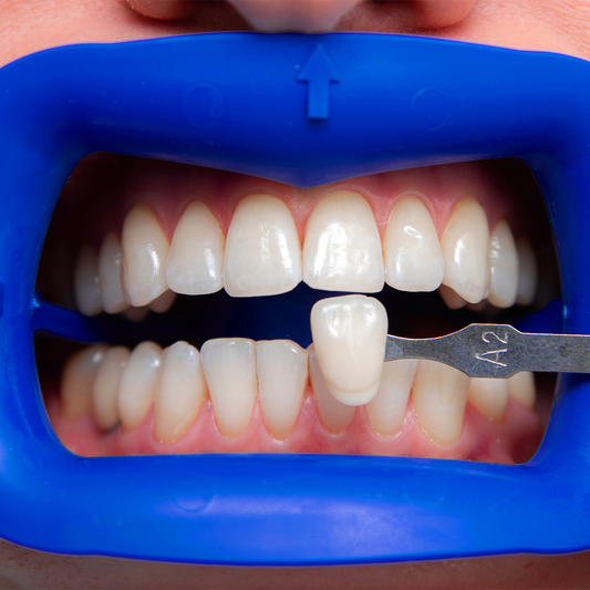 Composite Veneers