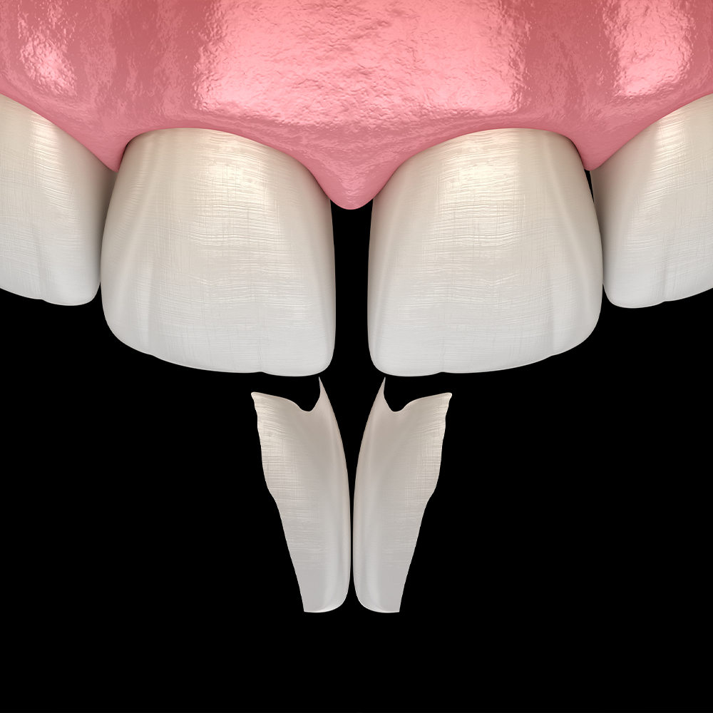 Tooth Gap Repair