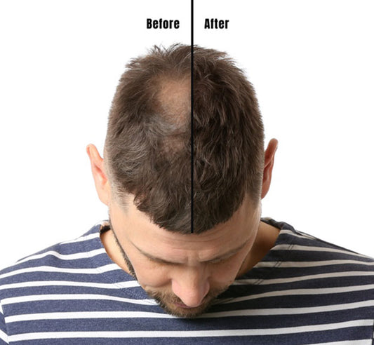 PRP Hair Restoration