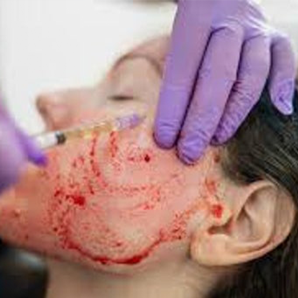 PRP Facial