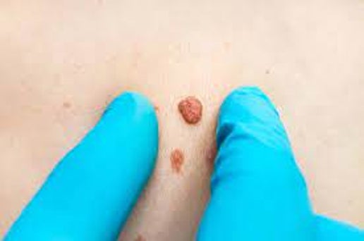 Skin Tag Removal